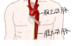 胸主动脉和腹主动脉图