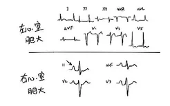 心室肥大心电图诊断标准图片