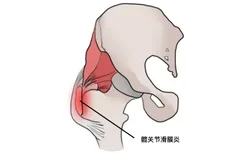 髋关节滑膜炎图片