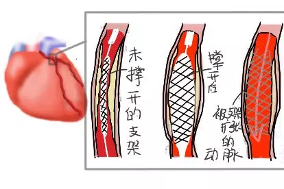 冠脉支架图片