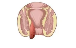 3度内痔脱出图片