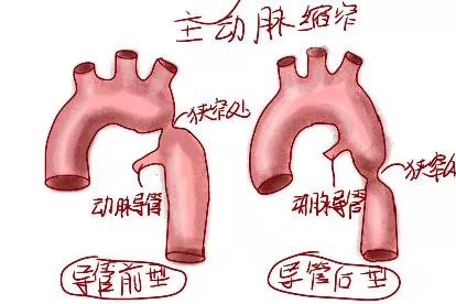 主动脉缩窄分型图片