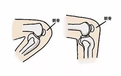 髌骨90度到120度的弯腿图片