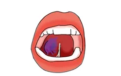 淋巴瘤舌头图片