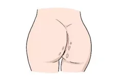 肛门瘢痕症状图片