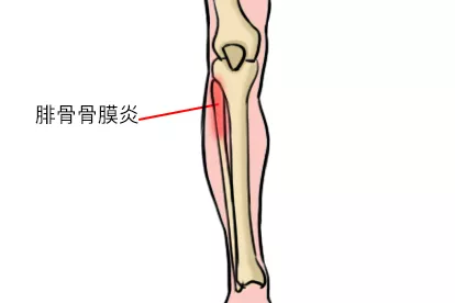 腓骨骨膜炎图片