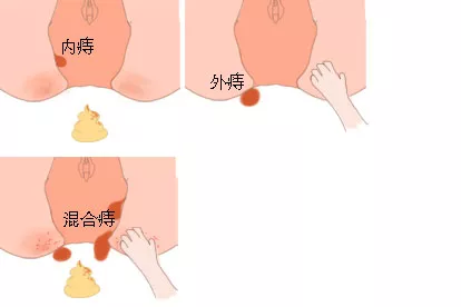 女性痔疮分类图片