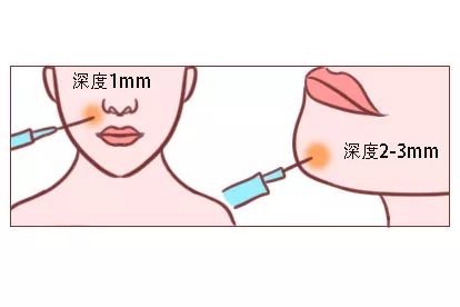 玻尿酸注射深度图