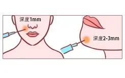 玻尿酸注射深度图解