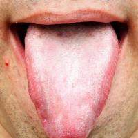 如果是肾阴虚 舌头有四大特征
